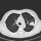 Aspergilloma, aspergillosis, angio-invasive aspergillosis, doubling time, initial scan, after treatment: CT - Computed tomography